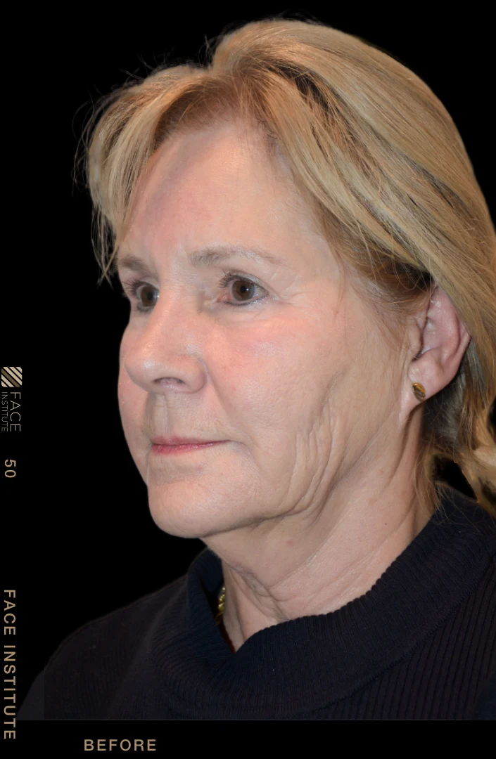 Deep plane facelift example 3 before