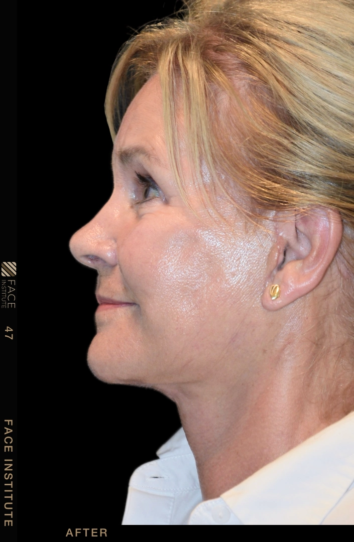 Deep plane facelift example 4 after