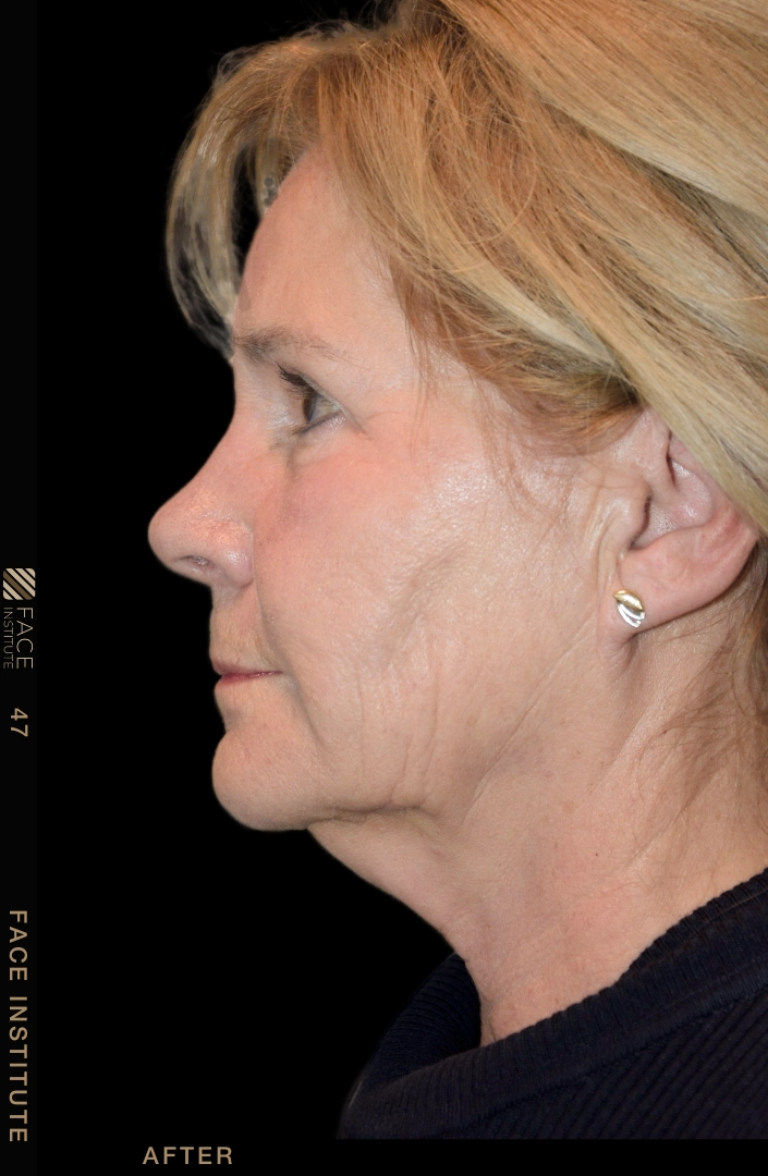 Deep plane facelift example 4 before