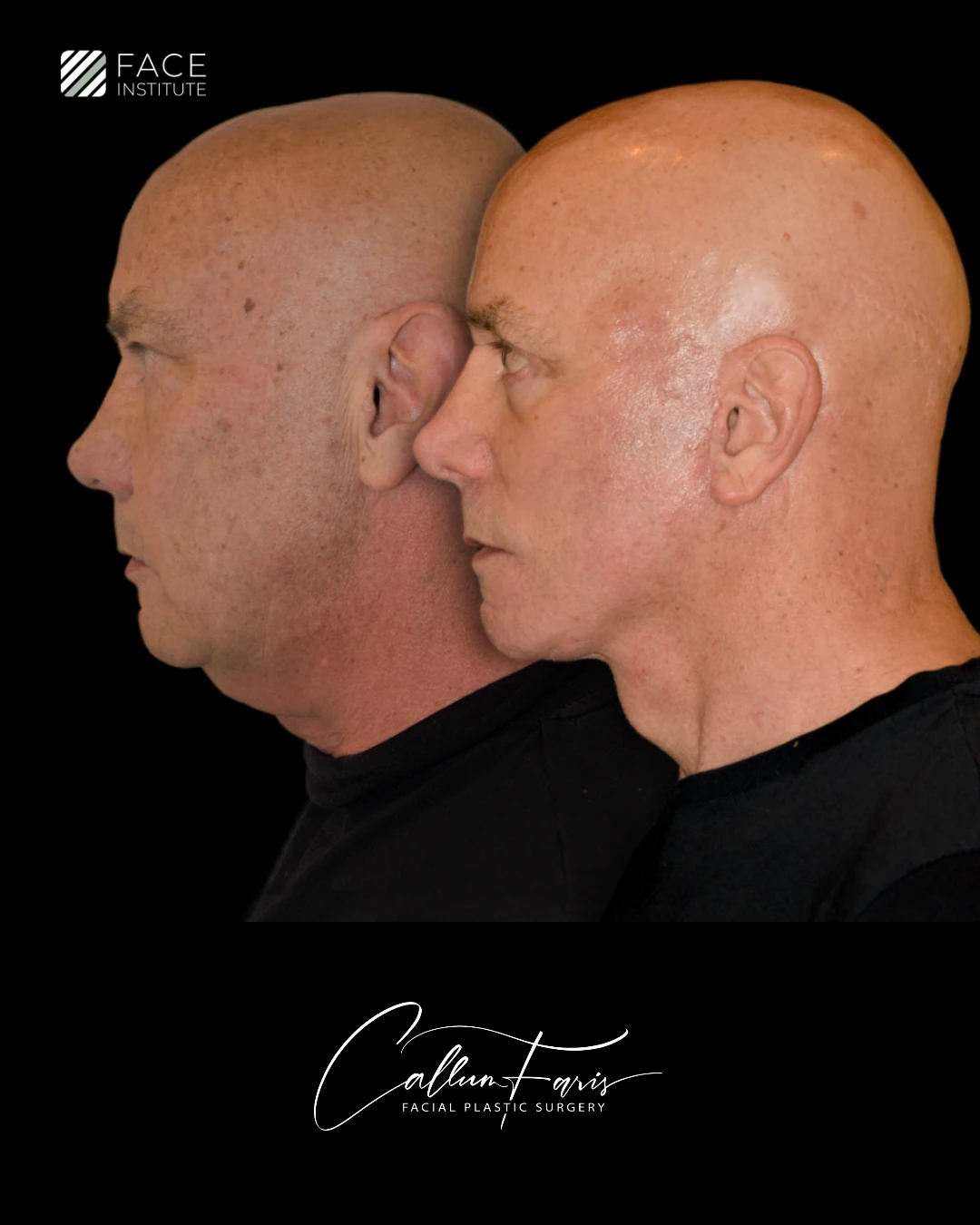 Before and After Example 6