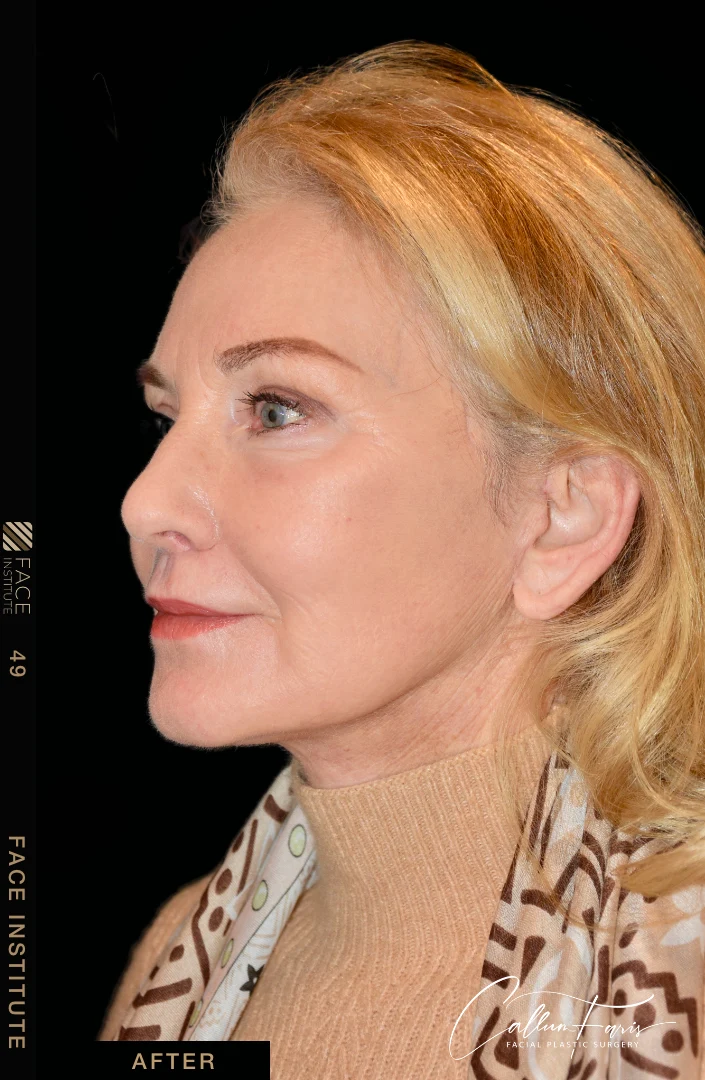 Deep plane facelift example 4 after