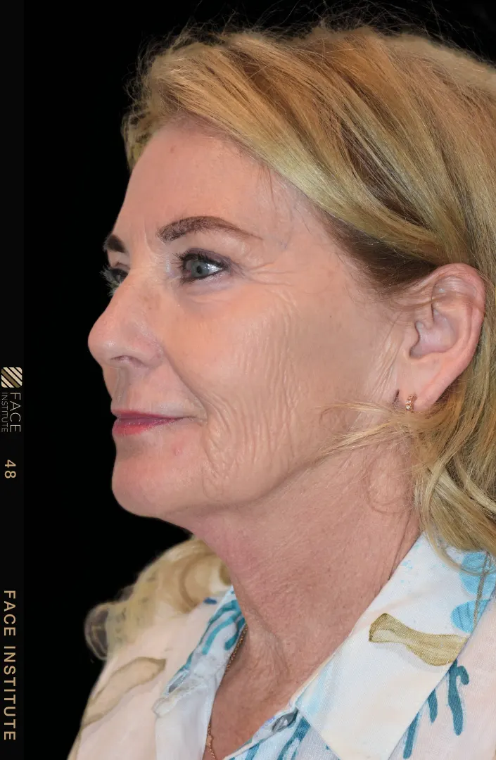 Deep plane facelift example 4 before