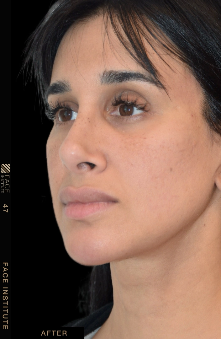 Deep plane facelift example 2 after