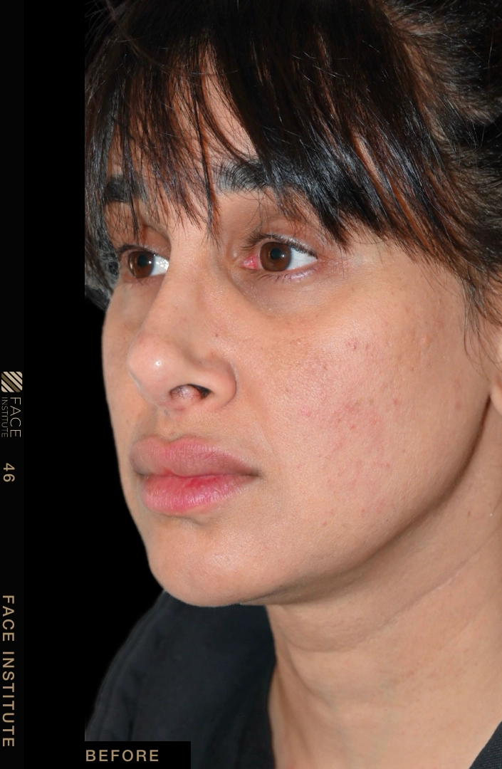 Deep plane facelift example 2 before
